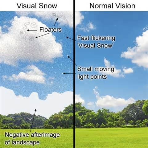 visual snow